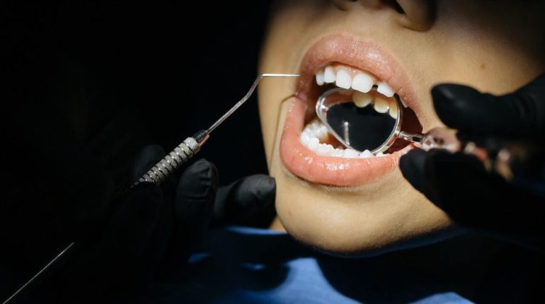 Jak usunąć próchnicę z zęba?
